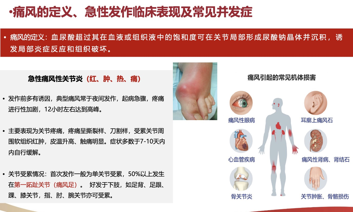 痛风急性发作如何