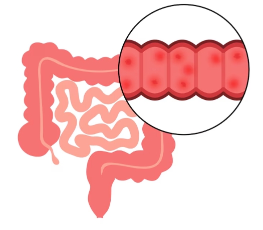 溃疡性结肠炎和克